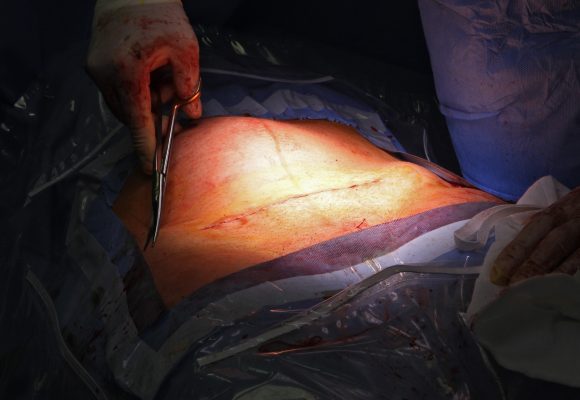 jizva po císařském porodu